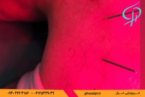 سوزن خشک برای درمان مشکلات گردن