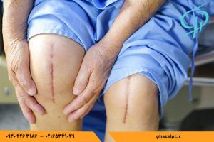 چه مدت باید فیزیوتراپی بعد از تعویض مفصل زانو انجام داد؟