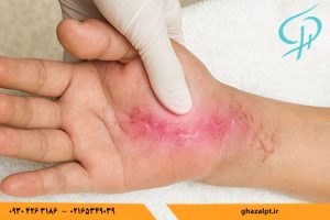 علائم چسبندگی زخم بعد از جراحی چیست؟