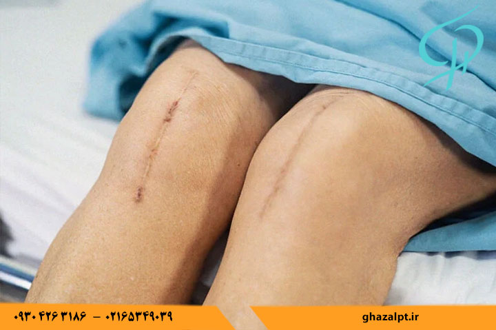 چطور فیزیوتراپی می تواند زخم را درمان کند؟