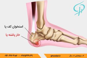 خارپاشنه چگونه تشخیص داده می شود؟