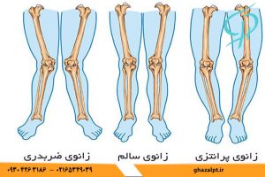 عوامل ایجاد زانوی پرانتزی چیست؟