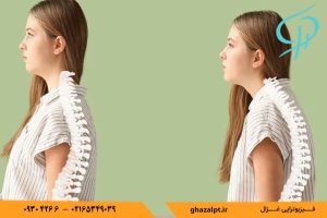 گوژپشتی چیست؟