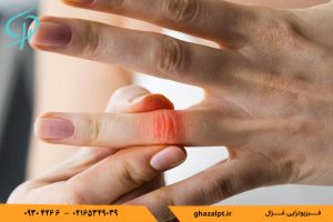 انگشت ماشه ای چیست؟