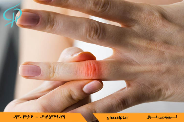 انگشت ماشه ای چیست؟