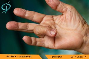 چطور علت انگشت ماشه ای را تشخیص دهیم؟